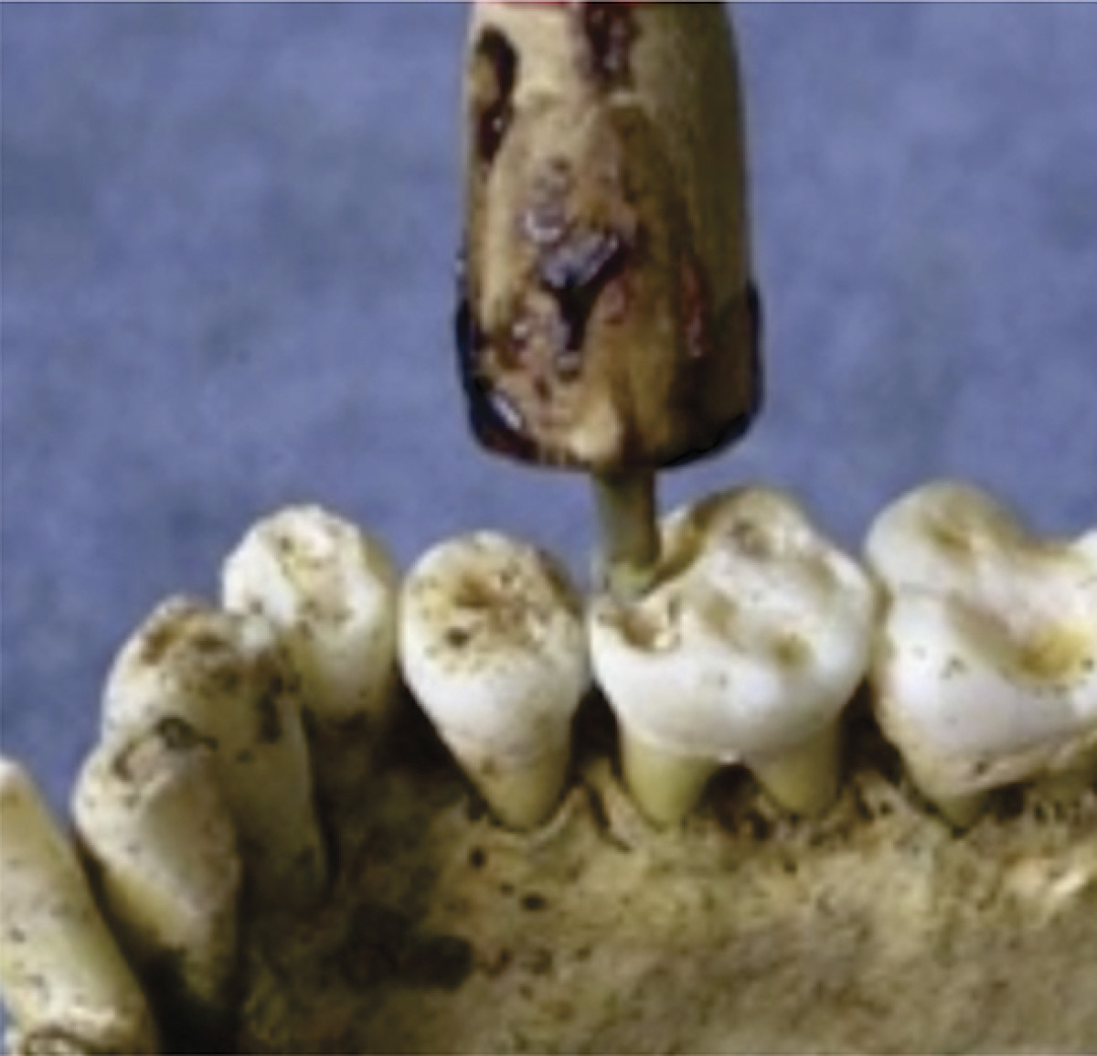 Stomatologiya qədimdə