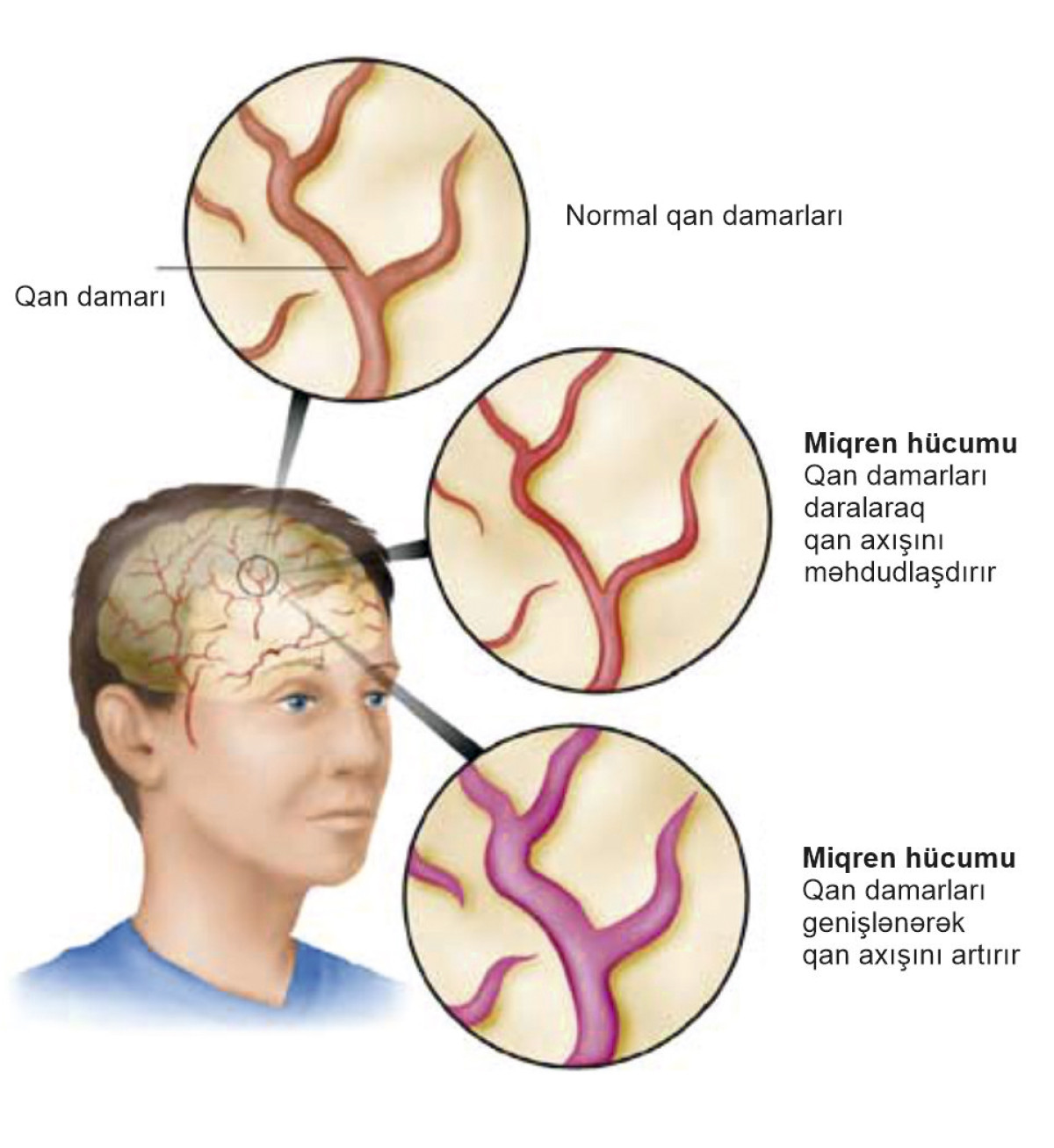 Miqren və onu törədən amillər